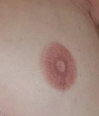 Areola pigment behandlung